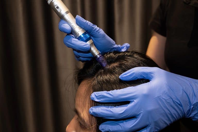 Microneedling For Hair Loss Procedure And Should You Get It 